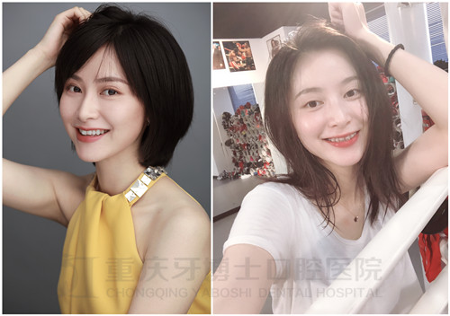 征集99名龅牙/牙不齐者0元体验隐形矫正