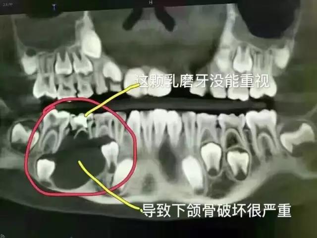 乳牙不重視造成孩子頜骨大面積吸收！誰的錯！