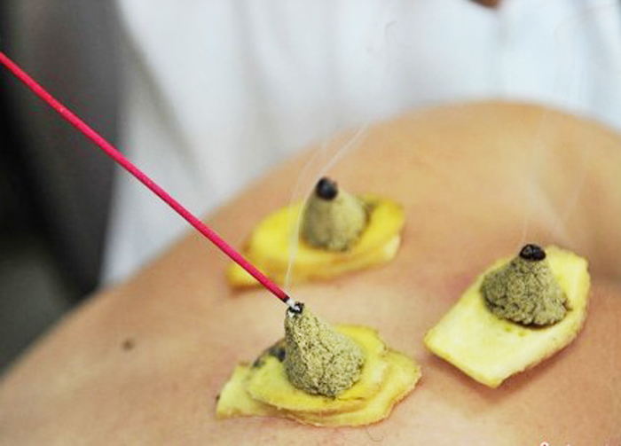 中医养生——"三伏"天灸疗法